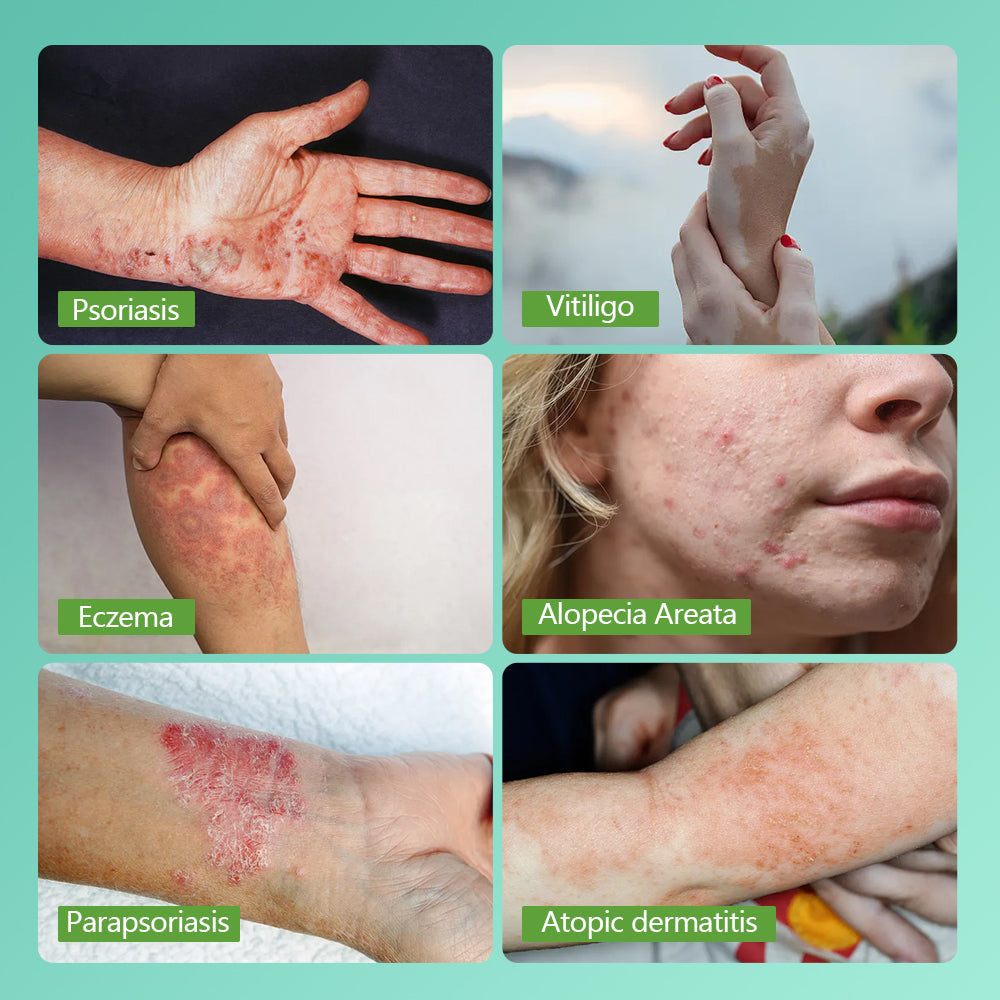 Terapia de Luz UVB 311nm para Psoríase e Vitiligo