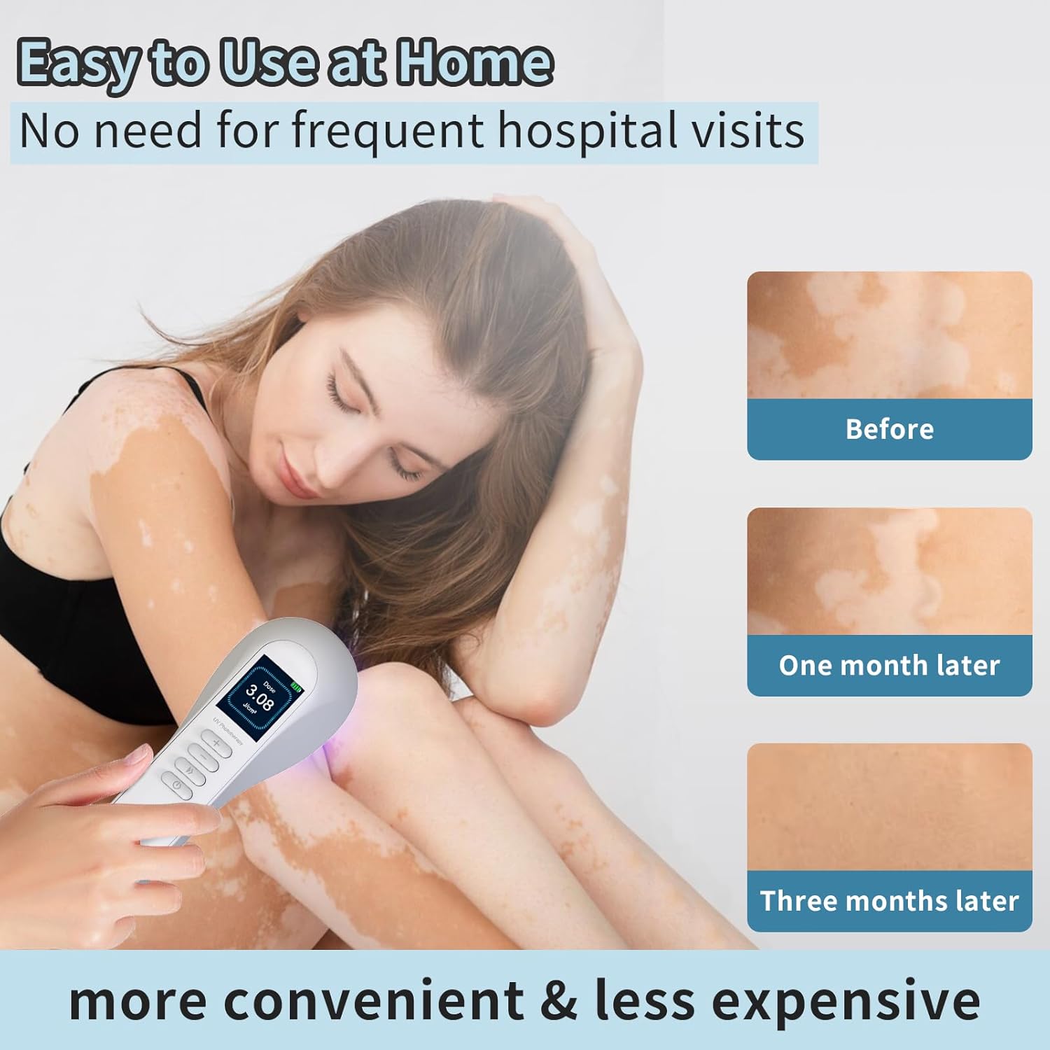 308nm UV-licht fototherapie LED-lamp voor thuisgebruik model