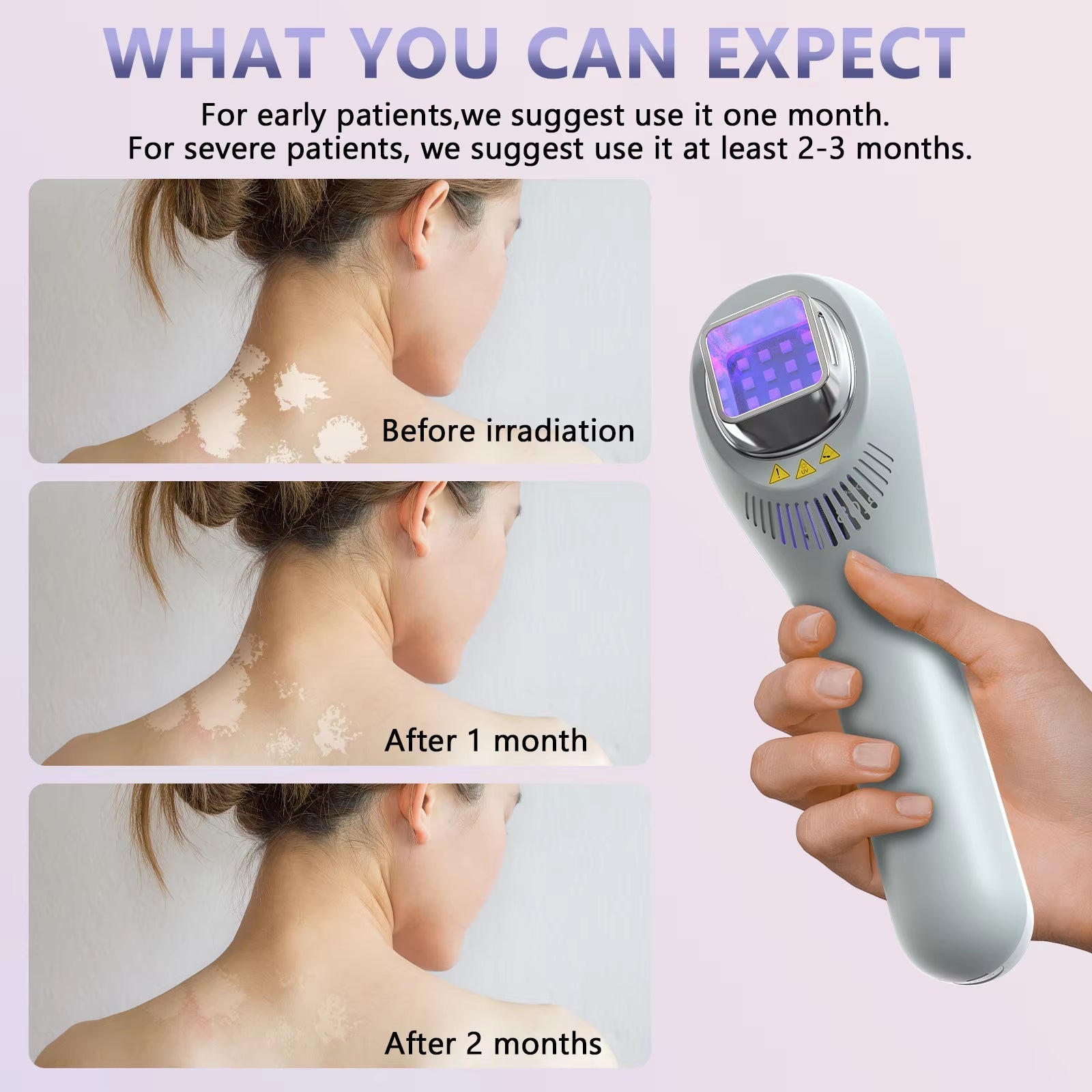 308 Nm UVB Fototerapilampe til Ansigt, Hals og Lemmer