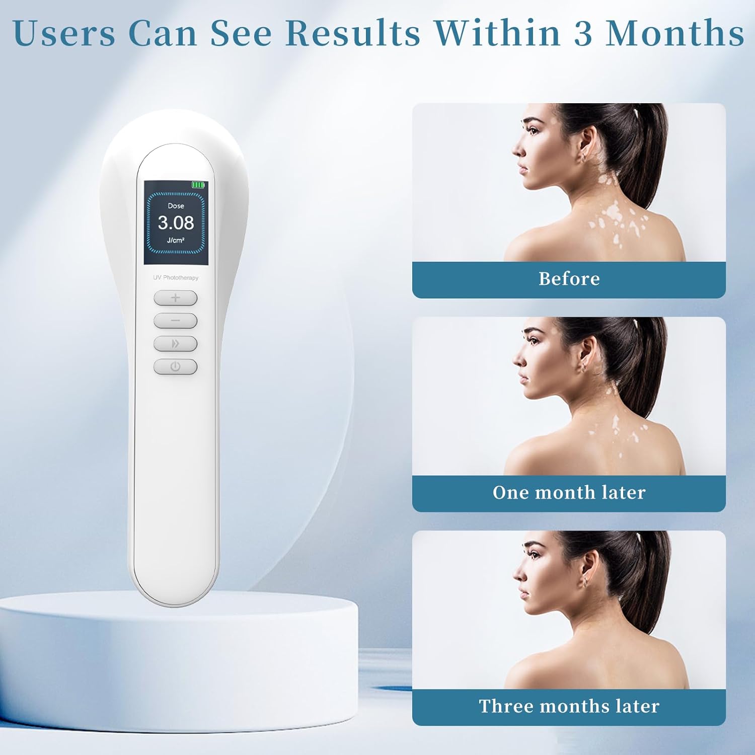 308nm UV-licht fototherapie LED-lamp voor thuisgebruik model