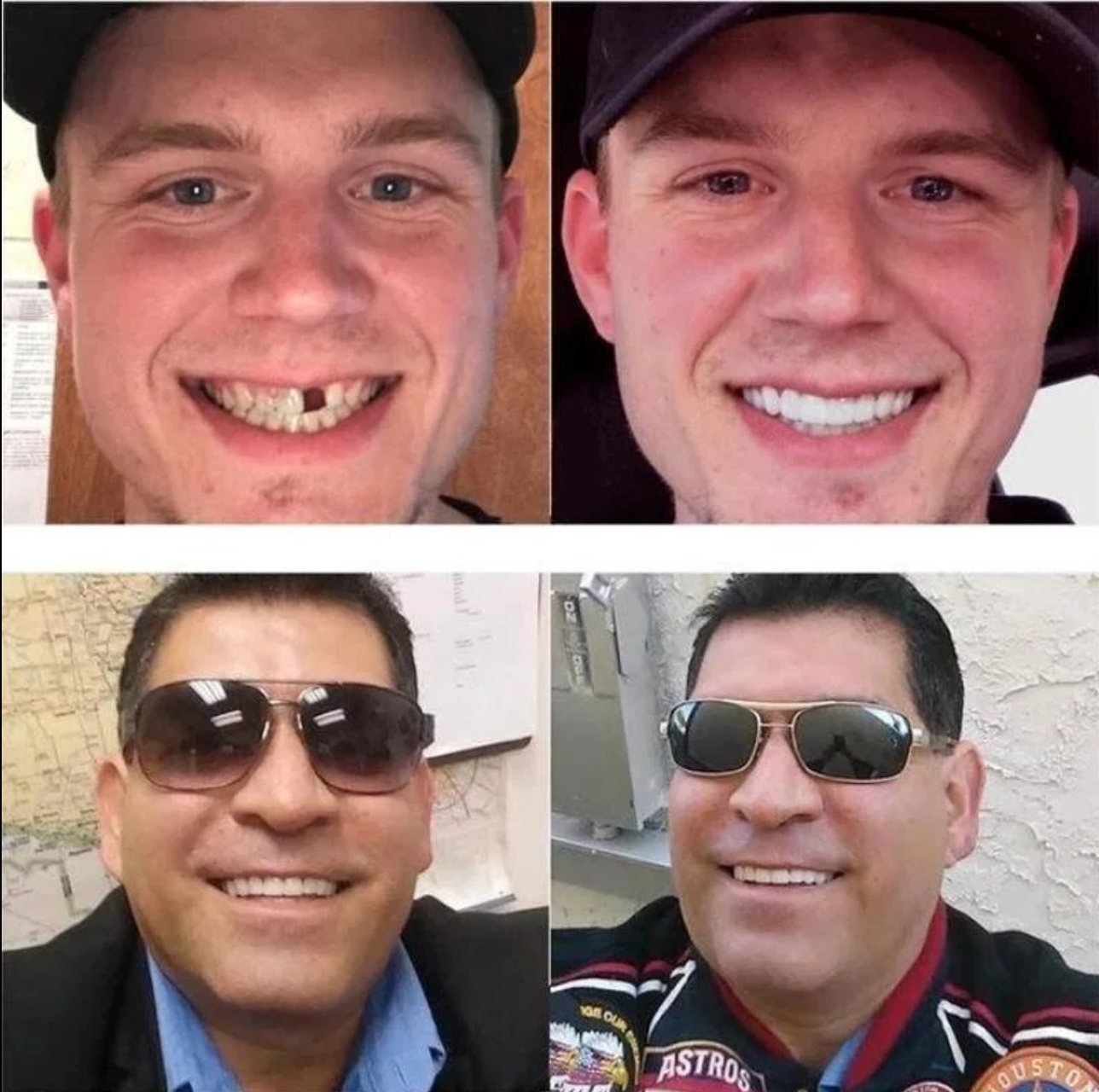 Alera állítható pattintós műfogsor a kényelmes étkezéshez